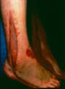 100. Fig. 12. The wound was closed by mesh graft on the lOth day with some of the incisions loosely closed by continuous tension suture, decreasing the area to be grafted. The tissue loss was limited to the distal toe tips and distal phalangeal tufts.