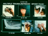104. Fig.15b. C-76l-82 #2. Frame #1: After the surgical reduction of the Monteggia fracture, the postoperative technetium 99m examination demonstrated a partial return of capillary perfusion to both hands. However, on the right hand, by the end of two weeks, severe necrosis, mummification, infection and the edematous reddish-orange discoloration of tissue necrosis and vascular failure is present. Frame #2: At 30 days, the dry, mummified tissues demarcating anatomically are present, and the hand is ready for surgical debridement. Frame #3: Eventually, guillotine modified, amputation of the metacarpophalangeal level on the right and at varied phalangeal levels on the left was performed -this at the end of four weeks. At six weeks, further debridement and split thickness skin cover of both hands was performed. Frame #4: Two months post-injury, an x-ray of the elbow revealed a soft tissue calcification extending anteriorly from the radial head region. This was mushroom-shaped, measuring approximately 3 by 3.5 cm, somewhat ovoid. It appeared to represent either a myositis ossificans or calcified hematoma. A radial-ulnar synostosis was present at the ulnar fracture site and site of operation. Frame #5: Six months post-trauma, the right elbow was explored anteriorly. A large, pedunculated bony mass was removed. The mass was found to have lifted the radial nerve upward for a distance of 2 cm, and displaced the radial artery and soft tissues. The mass originated from the radius, just below the radial head in the area of the annular ligament. The radial-ulnar synostosis was removed, permitting supination of 80 degrees, a motion previously lost. Fame #6: Ten months after injury, the patient has a &rsquo;paddle hand&rsquo; on the right with a segment of thumb and phalanx remaining. Small remnants of the proximal phalanges remain as well. On the left, sufficient phalangeal residual is present for the patient to continue his work as an electronic engineer. A large toe transfer for a right thumb and web space releases are contemplated further on the right hand. The findings in this case represent the disastrous results of severe associated fracture followed by thawing other than rapid rewarming, in this case spontaneous thawing, and represent the need for immediate care and early reduction of the fractures or dislocations. Thrombolytic therapy was inappropriate in this case because of the combined injuries to the head and neck and thoracic spine, the use of thrombolytic enzymes considered to likely cause intracranial or intraspinal bleeding.