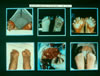117. Fig. 25. C-56. Frame #1: Deep frostbite, feet bilateral, after drinking episode in rural Alaska. Transferred with gangrenous toe tips by one week. Frame #2: Escaped hospital bed, irrational, and ran barefooted in snow till captured. Post-alcoholic encephalitis diagnosis. Frame #3: Necrotic tissues removed, fish mouth incision loosely closed over penrose, one suture, continued with whirlpool. Frame #4: Pain, swelling, hyperhydrosis, hypesthesia; and anesthesia residual digits. Frame #5: At revision operative procedure one and half years post injury, Avascular first metatarsal head revealed. Frame #6: Adequate weight bearing transmetatarsal amputation