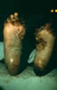 121. Fig. 29. C-402. Plantar views of feet had demonstrated area of edema, severe bleb formation on heels, with epidermal and dermal gangrenous skin change. Rx supportive care (see x-ray changes).