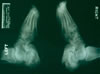 123. Fig. 31. C-402. Unexpectantly, avascular changes, with collapse of calcaneal structure occured. Asymptomatic due to neuropathy. Generally degenerative changes are not seen as early as four months post freezing..