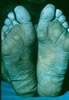 125. Fig. 1. U.S. Marine. Vietnam. Wann water immersion foot. Demonstrating pale. almost cyanotic feet with creases. wrinkling of toes and soles. Complaint of tingling and bumming.