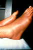 131. Fig 8. C-II0S 12-14-88 Early hyperemic stage. Swelling, &rsquo;redness&rsquo; edema generalized. Anesthesia of toes. Plantar arch aching, pain.