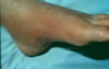 132. Fig.10. C-1106. 12-18-88. Hyperemia of foot and supra malleolar area, plantar pain upon weight bearing. Hypesthesia to anesthesia from mid foot to toes. No evidence of hammer toe deformity.