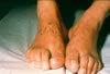 133. Fig 7. C-II04 6-21-90. Plantar pain, edema of feet. hyperhydrosis. Hammer toe deformity bilateral.