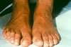 134. Fig.9. C-II05. 6-21-90. Intermittent hyperemia. Hammer toe marked on right. Diminished pedal pulses.
