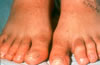 135. Fig.ll. C-II06. 6-21-90. Edema mild, with diminished pedal pulses. MP joint pain. Obvi hammer toe deformity of foot