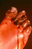 18. Fig.6: Five days following thawing, the foot wet, edematous and insensitive; the forefoot markedly necrotic, demonstrating rapid demarcation and separation between injured and viable tissues.