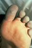 25. Fig. 17: A cold rigid forefoot without sensation or digital motion. Tissue compression and sock marks are obvious. Treatment was whirlpool bath and thawing at 110oF. for approximately twenty minutes.