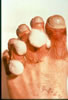 31. Fig. 26: There is continued loss of edema and pain on the left, but some early demarcation of the tips of toes 2 and 3. Anhydrosis on the left as compared to hyperhydrosis on the right.