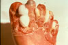 32. Fig. 27: Here, same data as Fig. No.26, but appearance of a similar injury is much different. There is still some superficial infection (Pseudomonas| continued edema, and pain. At the sixth post injury week, both feet were similar in appearance except that there had been greater tissue loss on the left (part of volar tips 2 and 3).