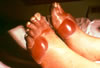33. Fig.13: The feet are approximately five days post-freezing and forty-eight hours post tha wing. Here a very poor prognostic sign is evident. The blebs are all proximal, and are dark. The toes and distal tissues are without blebs or blistering, and are dusky, edematous, painless and insensitive. Phalangeal amputation is generally unavoidable with this pattern and may be anticipated from the date of admission -as early as twenty-four hours post-thaw