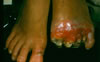 4. Premature debridement through wet, edematous tissues, (52 days post injury), resulting in retraction of tissues.