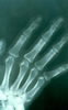 57. Fig.8 C-79. AP right hand. date of freezing 3-23-61. No degenerative joint changes visible.