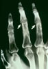 58. Fig.9 C-79. AP, right hand with early evidence of small discrete, periarticular IP joint destructive changes. Osteoporosis and early cortical destruction in periarticular areas.
