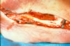 72. Fig.23. C-731 Fasciotomy, initial incision, less than six hours post-thawing, demonstrate swollen tissues, with clotting already present in the superficial veins. Operative procedure for increased compartment pressure.