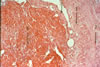 77. Fig.27. C-I079-88. Long standing wet-cold exposure, followed by freezing. Section of small peripheral artery of foot. I. Adventitia demonstrating non specific inflammation. 2. Tunica media with less obvious inflammation, with spindle shaped muscle fibers. 3. Thickened intima and circumferential muscle fibers. 4. Endothelial disruption growing into a luminal clot, with endotheliazation of thrombus. 5. Intra luminal clot being organized with in-growth of fibroblasts and capillaries.