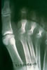 85. Fig.35. C-134-63 X-ray of right foot seven weeks post injury reveals no definite degenerative changes in phalanges.