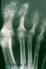 88. Fig.38. C-134-63. After 14 1/2 years, the narrowing of all joints persists, with periosticular joint areas of MP and IP joints demonstrating fibrin filled destructive lesions. Clinically the PIP joints of toes 3,4,5 are immobile. Hammer toe deformity has developed at DIP joint second toe and on toes 2-5 on left foot. MP joint motion, however, totaled 25 degrees on the right.