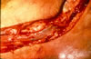 98. Fig.10. C-IO98-88. Multiple fasciotomy incisions both feet, medial and lateral, toe to mid-calf, Immediate color change, cyanosis to pink, extrusion of muscles and evidence of edematous neurovascular bundles with venous clotting, but almost immediate return of arterial pulses in posterior tibial medial and lateral plantar arteries. Fasciotomy extended distally until all tissues were mobile.